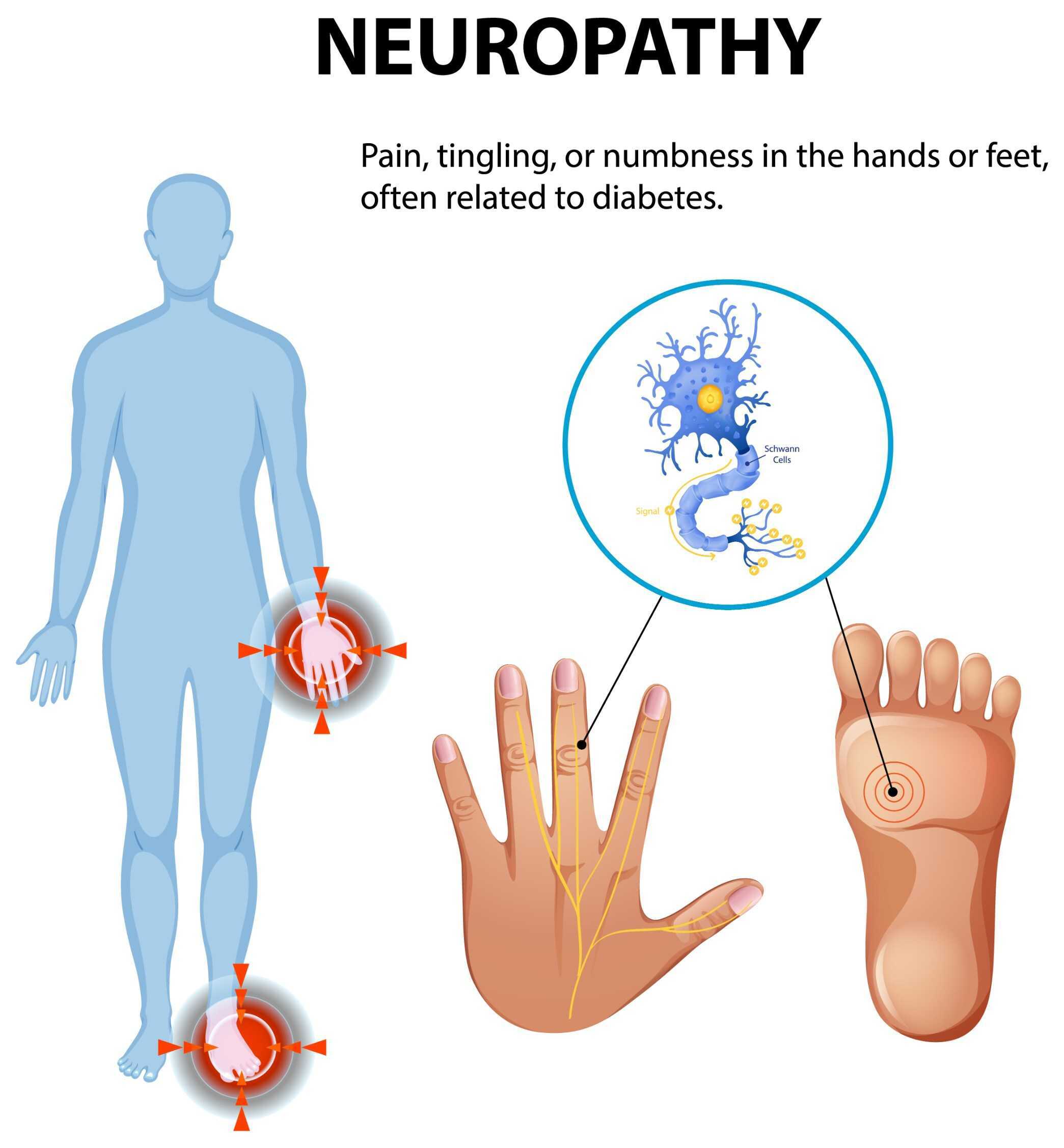 Neuropathy Treatment